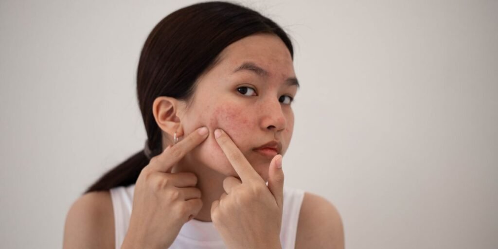 What Are the Best Skincare Products for Acne-Prone Skin?